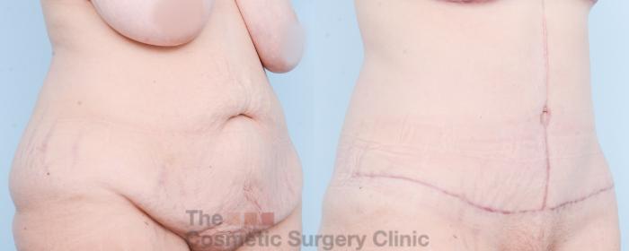 Before & After Tummy Tuck Case 825 Right Oblique View in Waterloo, Ontario