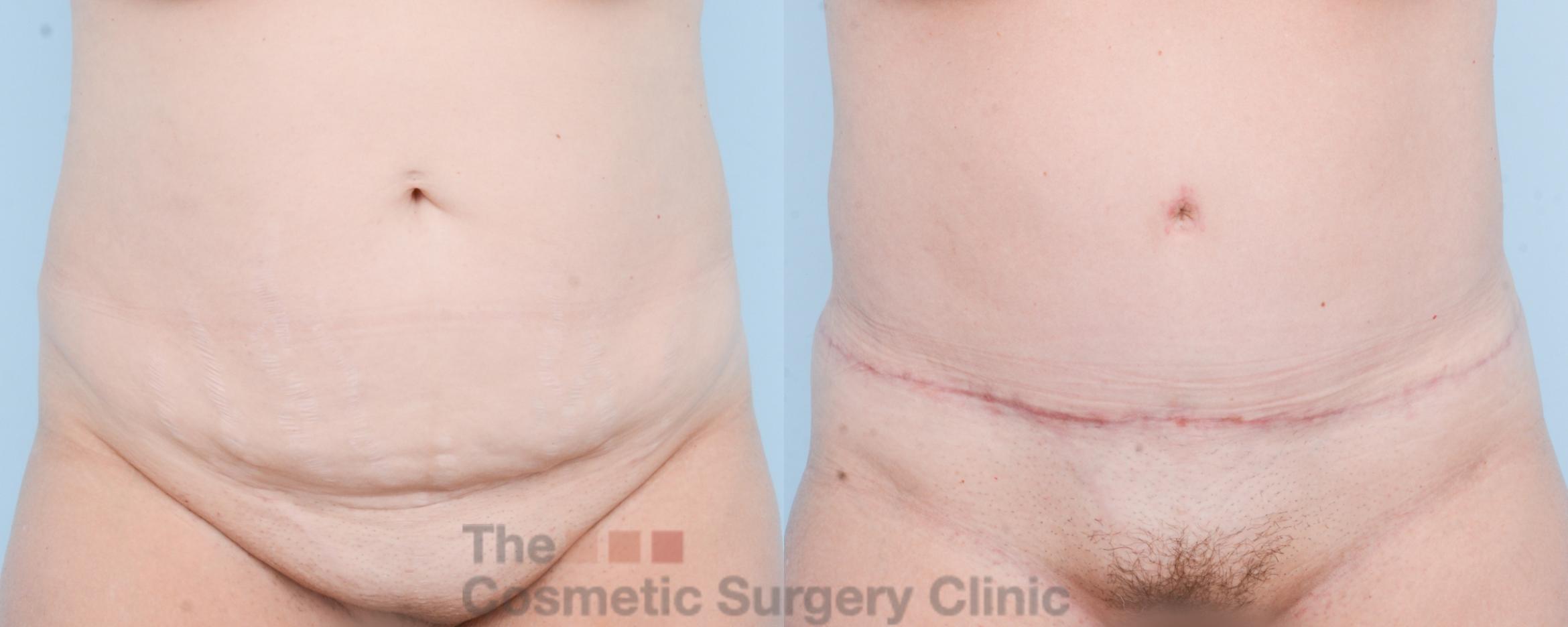 Before & After Tummy Tuck Case 832 Front View in Waterloo, Ontario