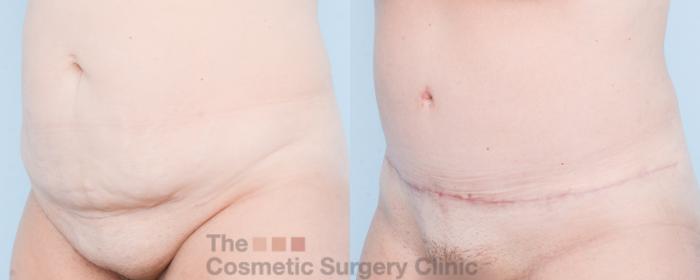 Before & After Tummy Tuck Case 832 Left Oblique View in Waterloo, Ontario