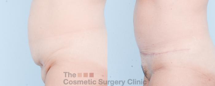 Before & After Tummy Tuck Case 832 Left Side View in Waterloo, Ontario