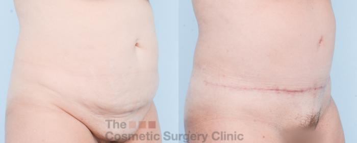 Before & After Tummy Tuck Case 832 Right Oblique View in Waterloo, Ontario