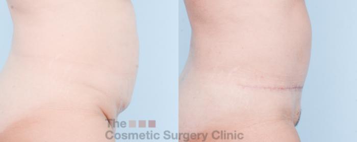 Before & After Tummy Tuck Case 832 Right Side View in Waterloo, Ontario