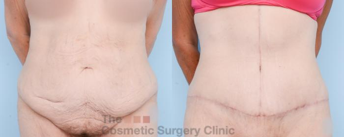 Before & After Tummy Tuck Case 837 Front View in Waterloo, Ontario