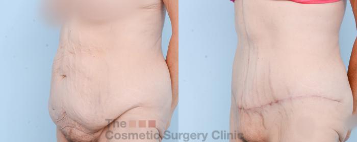 Before & After Tummy Tuck Case 837 Left Oblique View in Waterloo, Ontario