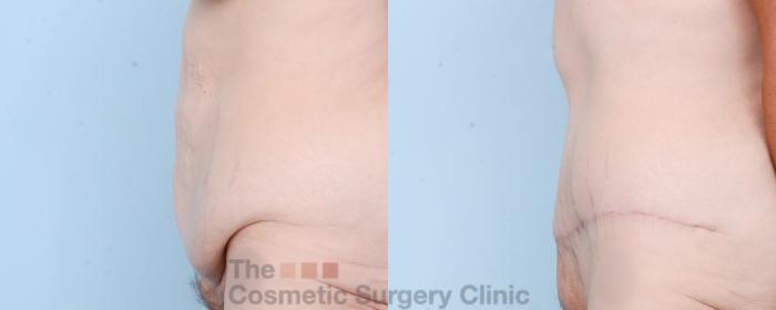 Before & After Tummy Tuck Case 837 Left Side View in Waterloo, Ontario