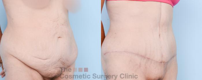 Before & After Tummy Tuck Case 837 Right Oblique View in Waterloo, Ontario
