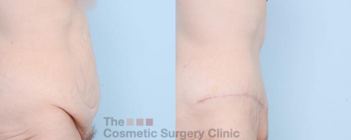 Before & After Tummy Tuck Case 837 Right Side View in Waterloo, Ontario