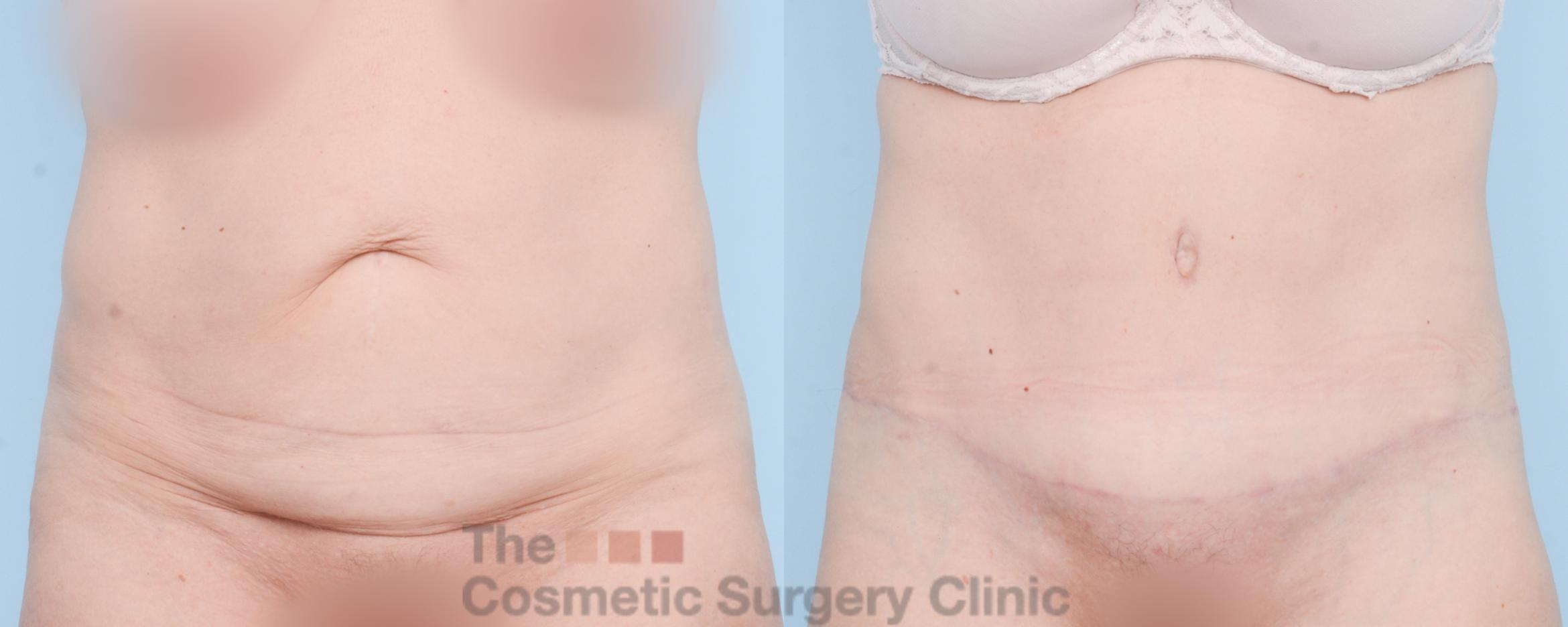 Before & After Tummy Tuck Case 839 Front View in Waterloo, Ontario