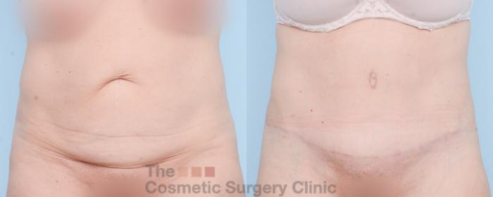 Before & After Tummy Tuck Case 839 Front View in Waterloo, Ontario