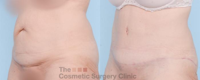 Before & After Tummy Tuck Case 839 Left Oblique View in Waterloo, Ontario