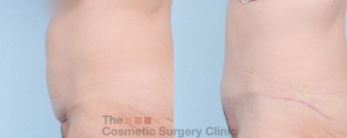 Before & After Tummy Tuck Case 839 Left Side View in Waterloo, Ontario