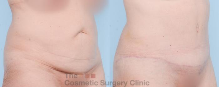 Before & After Tummy Tuck Case 839 Right Oblique View in Waterloo, Ontario