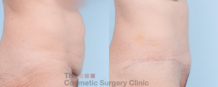 Before & After Tummy Tuck Case 839 Right Side View in Waterloo, Ontario