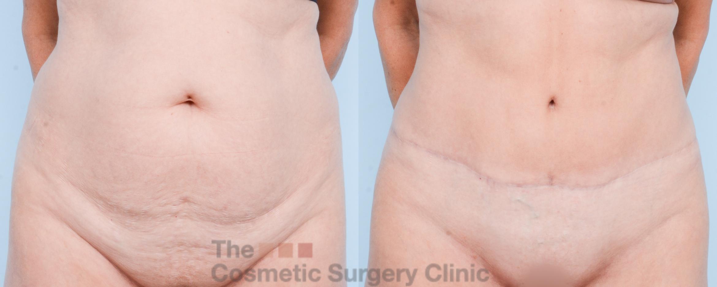Before & After Tummy Tuck Case 846 Front View in Waterloo, Ontario