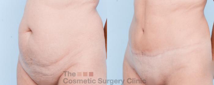 Before & After Tummy Tuck Case 846 Left Oblique View in Waterloo, Ontario