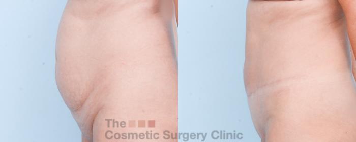 Before & After Tummy Tuck Case 846 Left Side View in Waterloo, Ontario