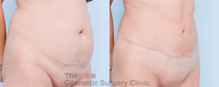 Before & After Tummy Tuck Case 846 Right Oblique View in Waterloo, Ontario