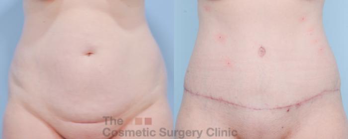 Before & After Tummy Tuck Case 854 Front View in Waterloo, Ontario