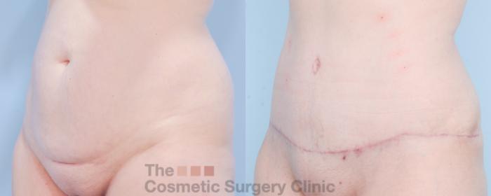Before & After Tummy Tuck Case 854 Left Oblique View in Waterloo, Ontario