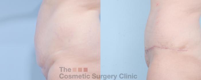 Before & After Tummy Tuck Case 854 Left Side View in Waterloo, Ontario