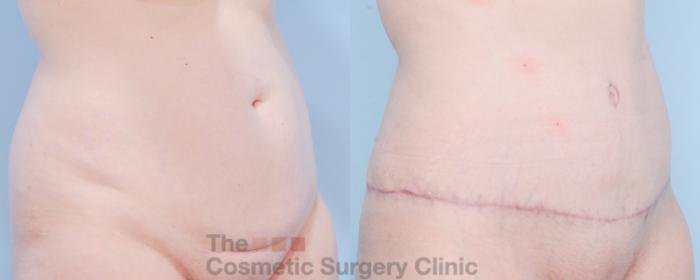 Before & After Tummy Tuck Case 854 Right Oblique View in Waterloo, Ontario
