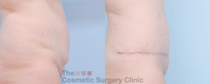 Before & After Tummy Tuck Case 854 Right Side View in Waterloo, Ontario