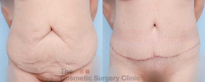 Before & After Tummy Tuck Case 859 Front View in Waterloo, Ontario