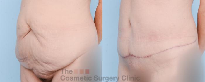 Before & After Tummy Tuck Case 859 Left Oblique View in Waterloo, Ontario