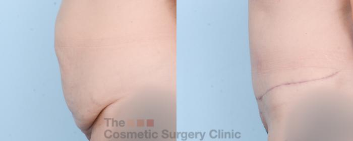 Before & After Tummy Tuck Case 859 Left Side View in Waterloo, Ontario
