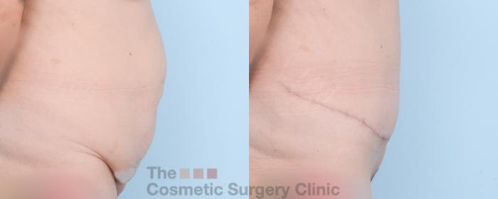 Before & After Tummy Tuck Case 859 Right Side View in Waterloo, Ontario