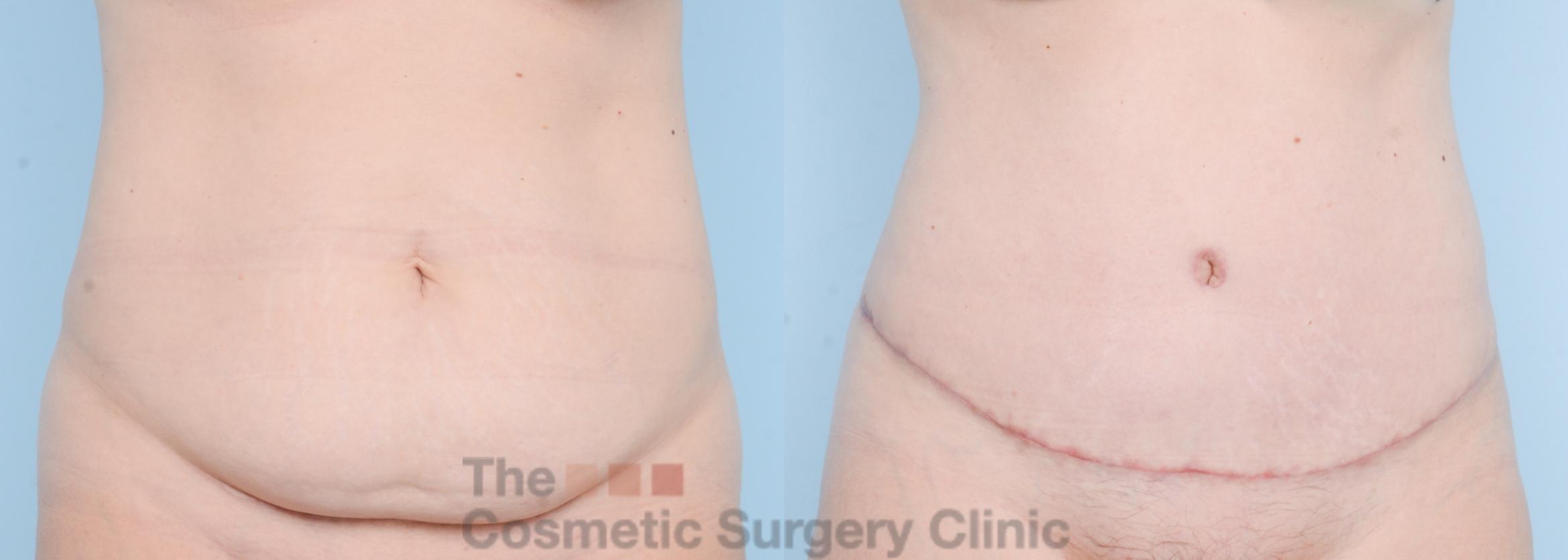 Before & After Tummy Tuck Case 861 Front View in Waterloo, Ontario