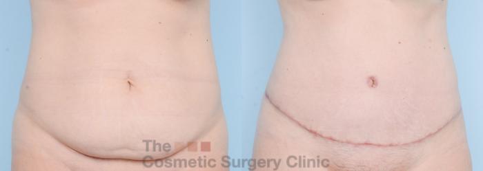 Before & After Tummy Tuck Case 861 Front View in Waterloo, Ontario