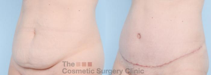 Before & After Tummy Tuck Case 861 Left Oblique View in Waterloo, Ontario