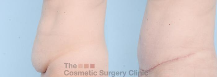 Before & After Tummy Tuck Case 861 Left Side View in Waterloo, Ontario