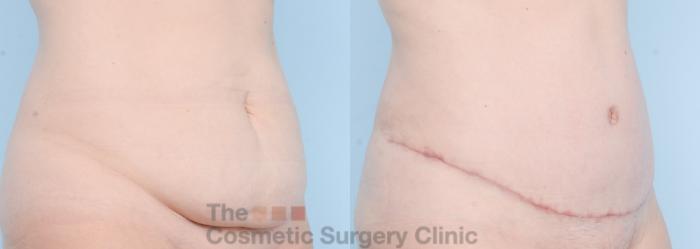 Before & After Tummy Tuck Case 861 Right Oblique View in Waterloo, Ontario