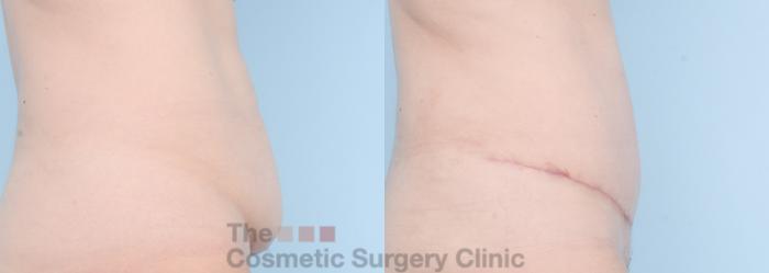 Before & After Tummy Tuck Case 861 Right Side View in Waterloo, Ontario