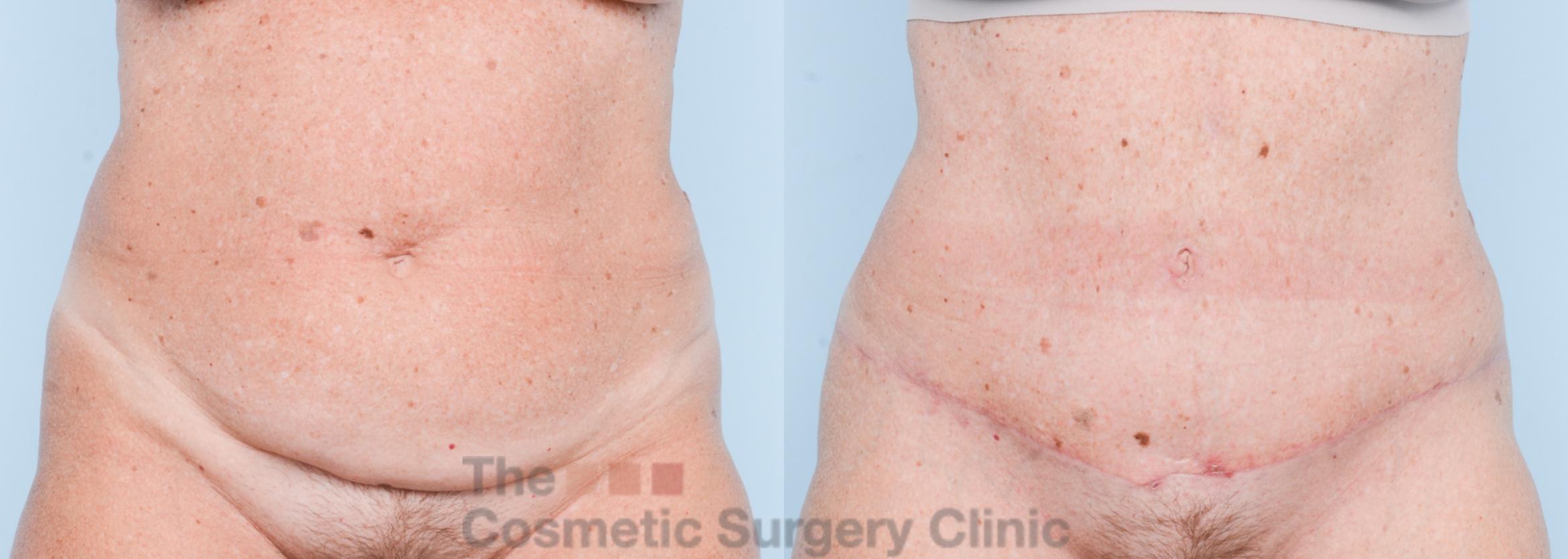 Before & After Tummy Tuck Case 862 Front View in Waterloo, Ontario