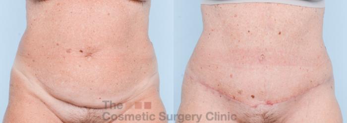 Before & After Tummy Tuck Case 862 Front View in Waterloo, Ontario