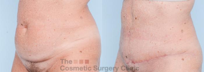 Before & After Tummy Tuck Case 862 Left Oblique View in Waterloo, Ontario