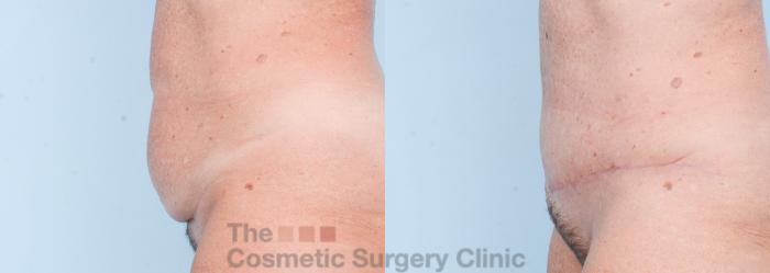 Before & After Tummy Tuck Case 862 Left Side View in Waterloo, Ontario