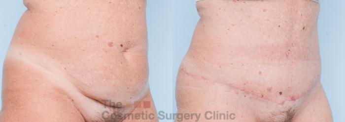 Before & After Tummy Tuck Case 862 Right Oblique View in Waterloo, Ontario