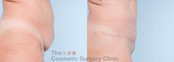 Before & After Tummy Tuck Case 862 Right Side View in Waterloo, Ontario