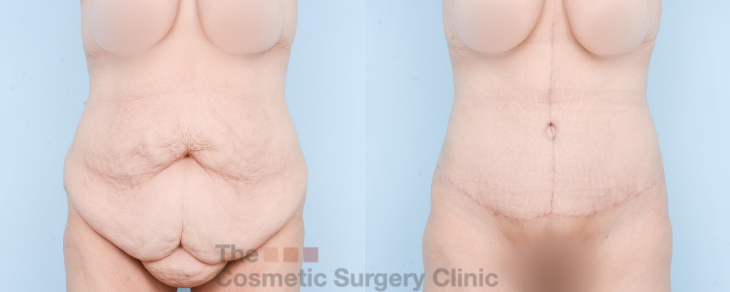 Before & After Tummy Tuck Case 870 Front View in Waterloo, Ontario