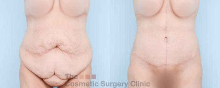 Before & After Tummy Tuck Case 870 Front View in Waterloo, Ontario