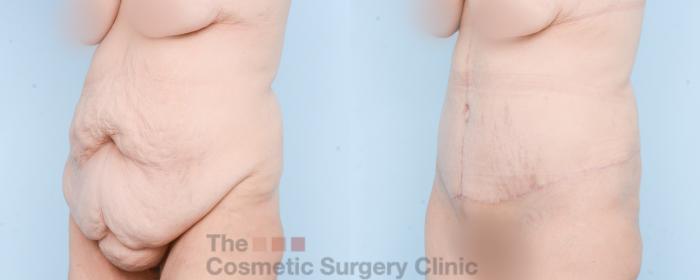 Before & After Tummy Tuck Case 870 Left Oblique View in Waterloo, Ontario