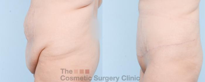 Before & After Tummy Tuck Case 870 Left Side View in Waterloo, Ontario