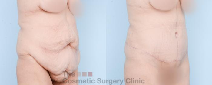Before & After Tummy Tuck Case 870 Right Oblique View in Waterloo, Ontario