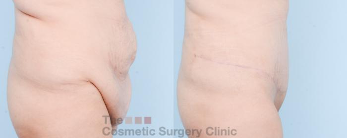 Before & After Tummy Tuck Case 870 Right Side View in Waterloo, Ontario