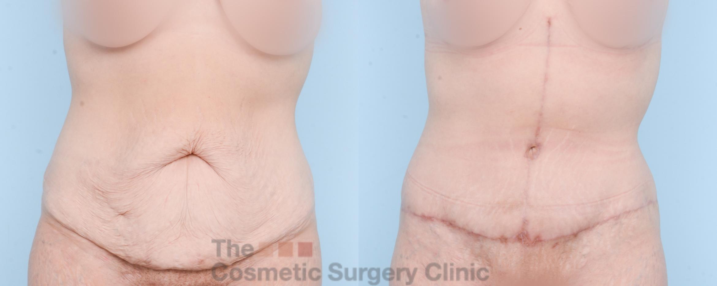 Before & After Tummy Tuck Case 875 Front View in Waterloo, Ontario