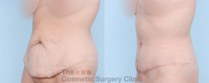 Before & After Tummy Tuck Case 875 Left Oblique View in Waterloo, Ontario